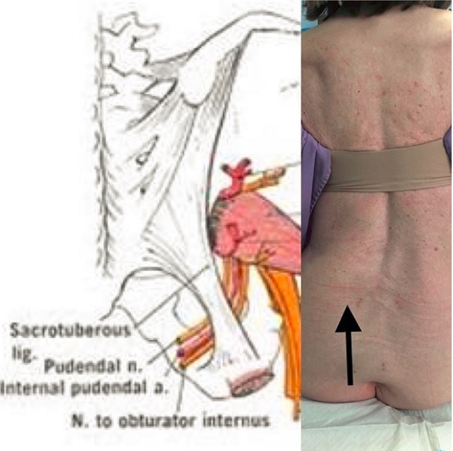 Scoliosis As A Cause Of Chronic Pelvic Pain Pamela Morrison