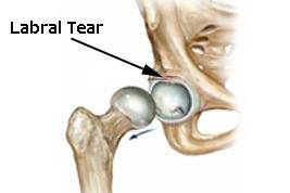 hip labaral tears