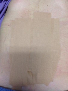 taping techniques effective for improving distasis recti_2