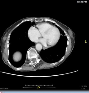 abdominal pain abdominal adhesions