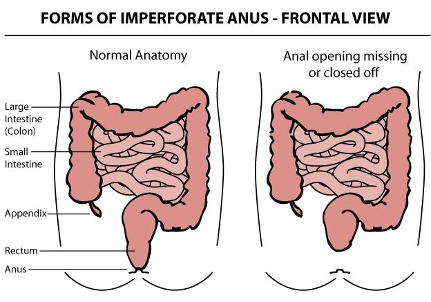Forms of Imperforate Anus - Frontal View