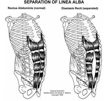 Diastasis Recti - Separation of Linea Alba