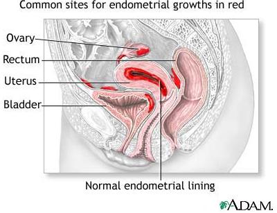 Endometriosis - Common Sites For Endometrial Growths