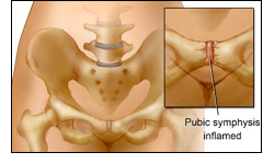 Pubic Symphysis Inflamed