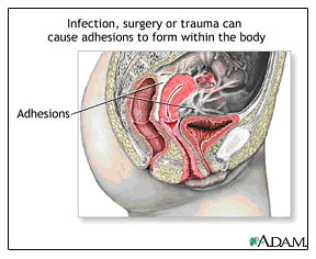 Infertility - Adhesions formed from Infection, Surgery, or Trauma
