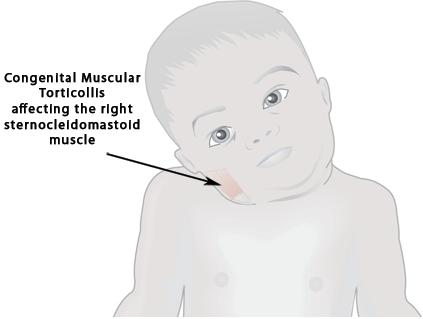 Congenital Muscular Torticollis Affecting the Right Sternocleidomastoid Muscle