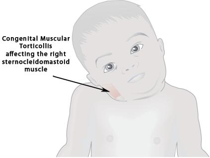 https://www.pamelamorrisonpt.com/wp-content/uploads/2015/05/torticollis.jpg