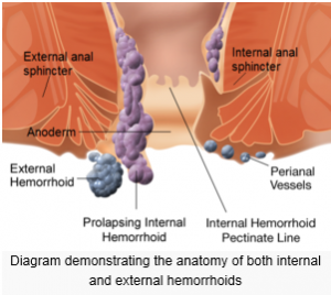 hemmorrhoid