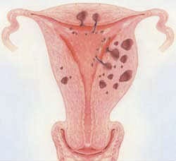 Adenomyosis How to