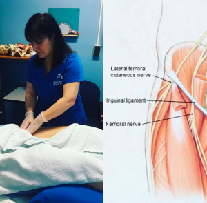 Ilioinguinal Ligament Pain: Relieve Groin Pain with Ilioinguinal Ligament  Support!